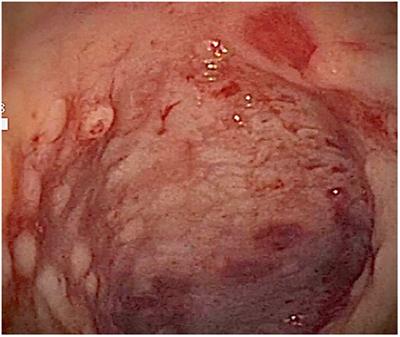 Case Report: An early-onset inflammatory colitis due to a variant in TNFAIP3 causing A20 haploinsufficiency